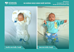 CHÚC MỪNG BÉ HOÀNG NGỌC MINH NHẬT (CA SỐ 574) ĐÃ RA VIỆN!