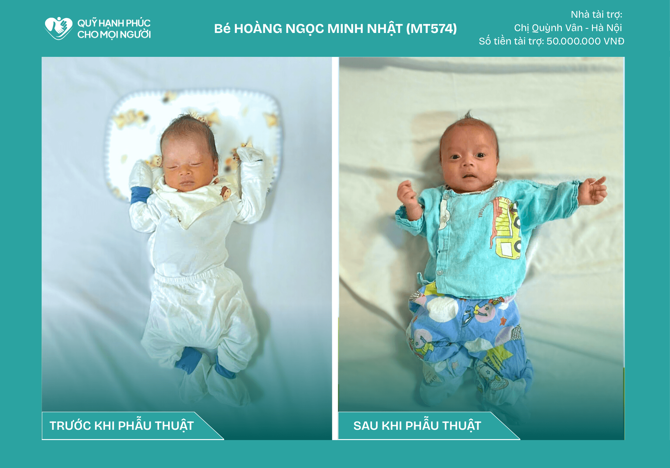 CHÚC MỪNG BÉ HOÀNG NGỌC MINH NHẬT (CA SỐ 574) ĐÃ RA VIỆN!