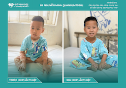 CHÚC MỪNG BÉ NGUYỄN MINH QUANG (MT598) ĐÃ ĐƯỢC RA VIỆN! ❤️