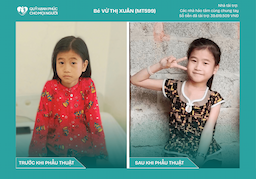 CHÚC MỪNG BÉ VỪ THỊ XUÂN (MT599) ĐÃ ĐƯỢC RA VIỆN ❤️